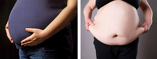 2 photos showing maternal obesity
