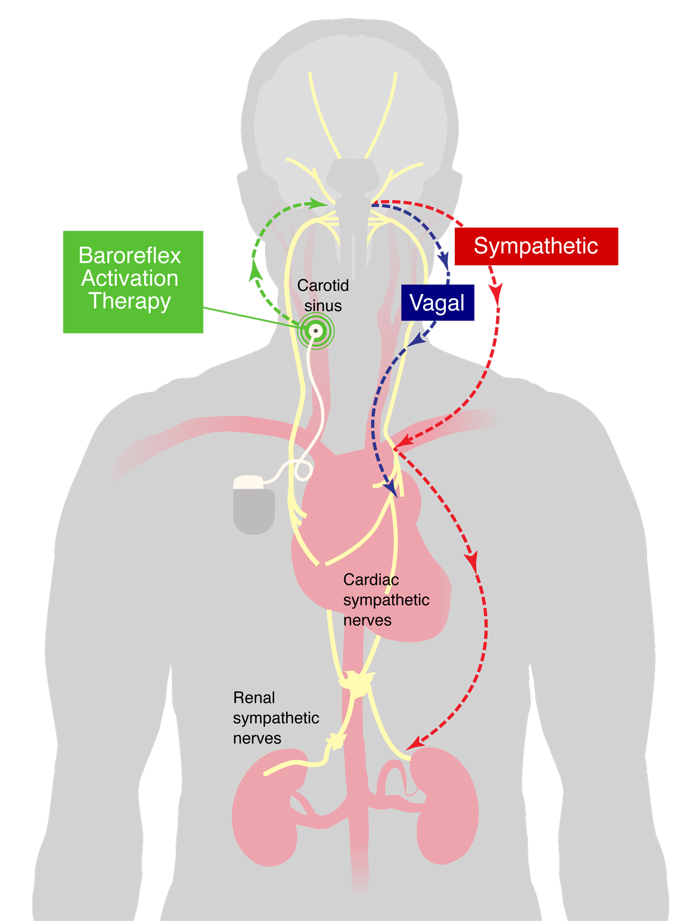 Barostim Implantation diagram