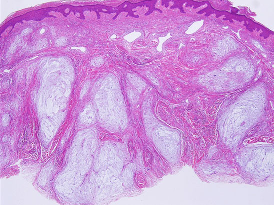 myxoid neurothekeoma