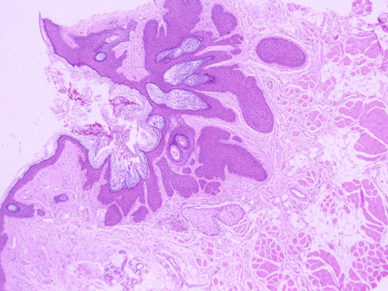 pilar sheath acanthoma