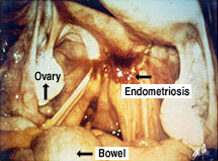 Endometriosis figure 1
