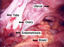 Endometriosis figure 2