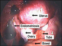 Endometriosis figure 3