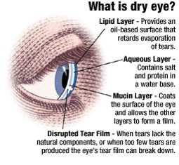 diagram of dry eye symptoms