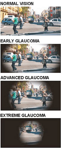 4 photos showing glaucoma syptoms