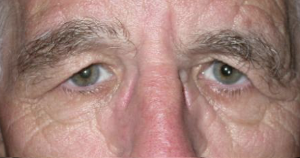 Before upper blepharoplasty both eyes