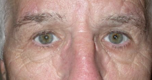 After upper blepharoplasty both eyes