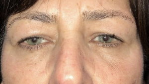 Before upper blepharoplasty both eyes