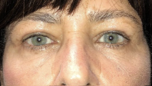 After upper blepharoplasty both eyes