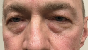 Before upper and lower blepharoplasty