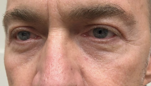 After upper and lower blepharoplasty