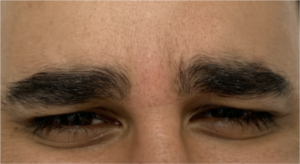 After Botox to eyebrow frown lines