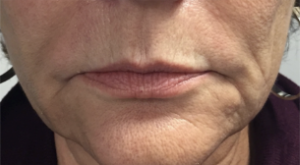 Before injection of filler to lips and marionette lines