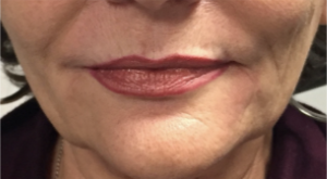 After injection of filler to lips and marionette lines