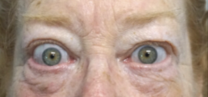 Before repair of upper eyelid retraction