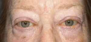 After repair of upper eyelid retraction