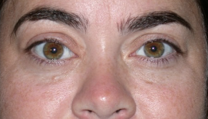 After Right orbital decompression and eyelid retraction repair