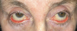 Before lower lid ectropion repair both eyes