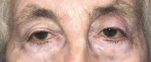 After lower lid ectropion repair both eyes