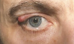Before chalazion excision