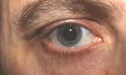 After chalazion excision