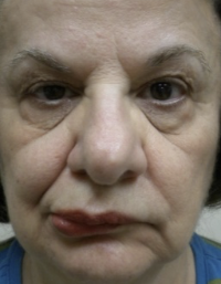 Before upper lid Botox injection