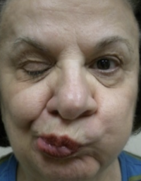 Before upper lid Botox injection