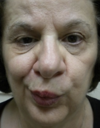 After upper lid Botox injection