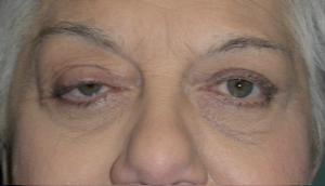 Before right ptosis repair