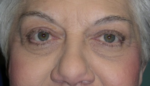 After Right ptosis repair