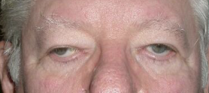 Before upper blepharoplasty and ptosis repair both eyes