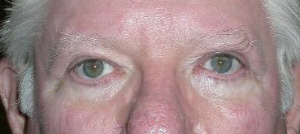 After upper blepharoplasty and ptosis repair both eyes