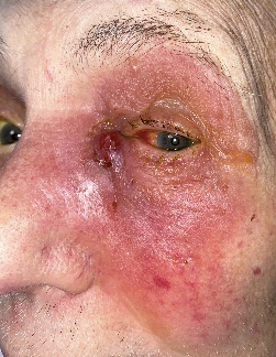 Infection from blocked tear duct