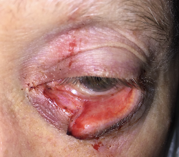 Before lower eyelid laceration involving tear duct
