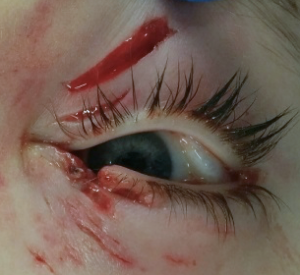 Before repair of eyelid lacerations