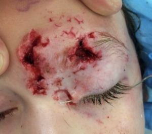 Before repair of eyelid and eyebrow lacerations