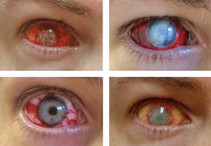 4 photo of injured eyes