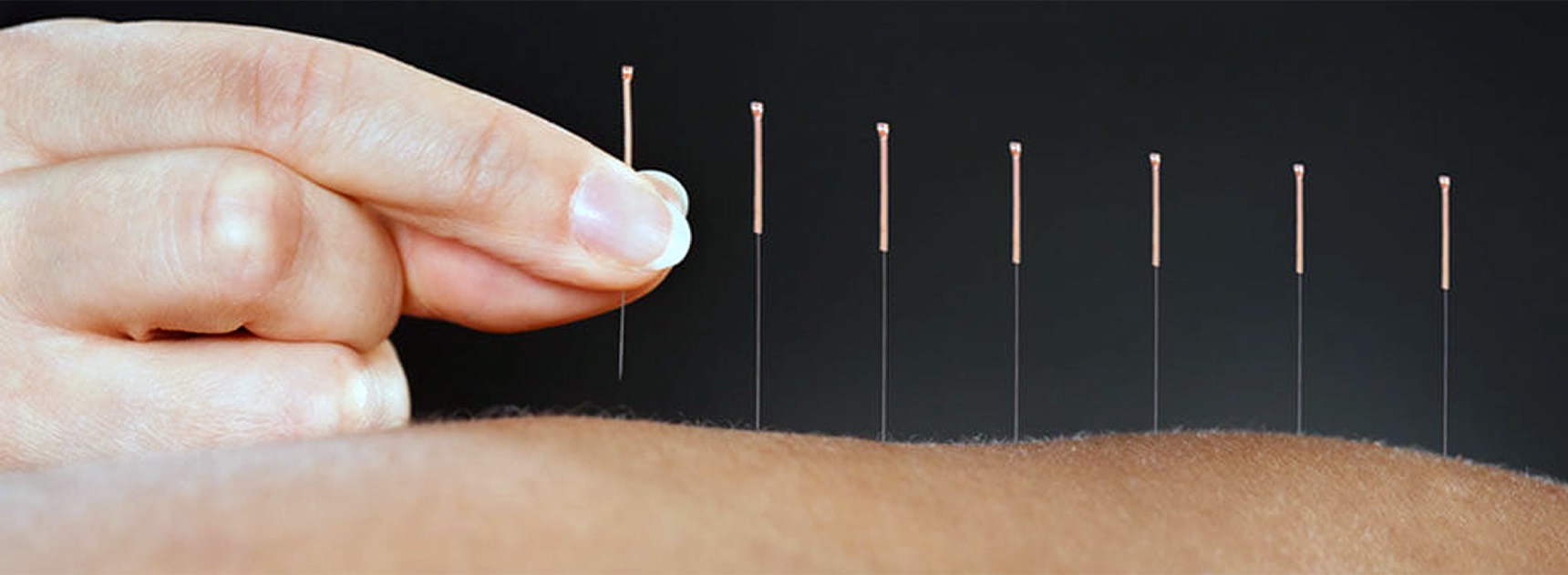 acupuncture