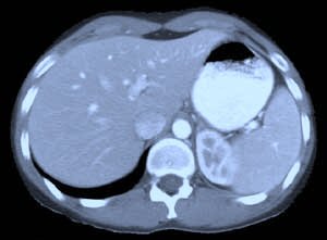 CT Abdominal Scan