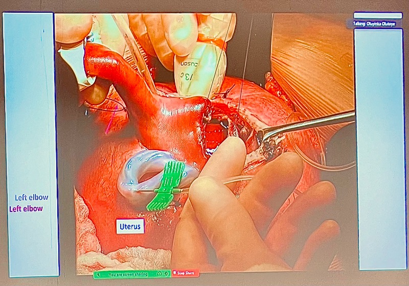 fetoscopic surgery photo