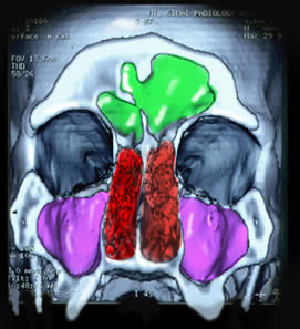 Apprasial of Asian Homo Erectus Crainal Variation