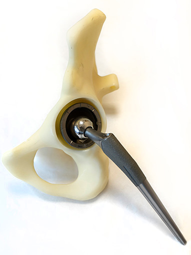 photo of artificial hip