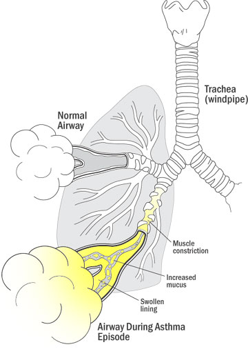 asthma attak illustration