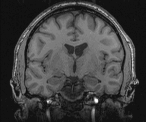 MRI scan of brain