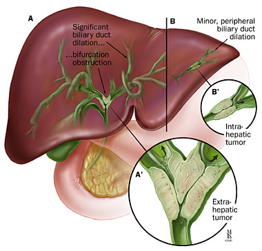 Bile Duct