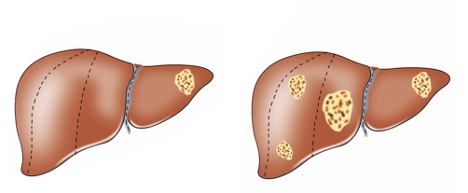 Metastatic Liver Cancer