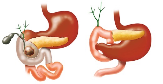 Pancreas 2